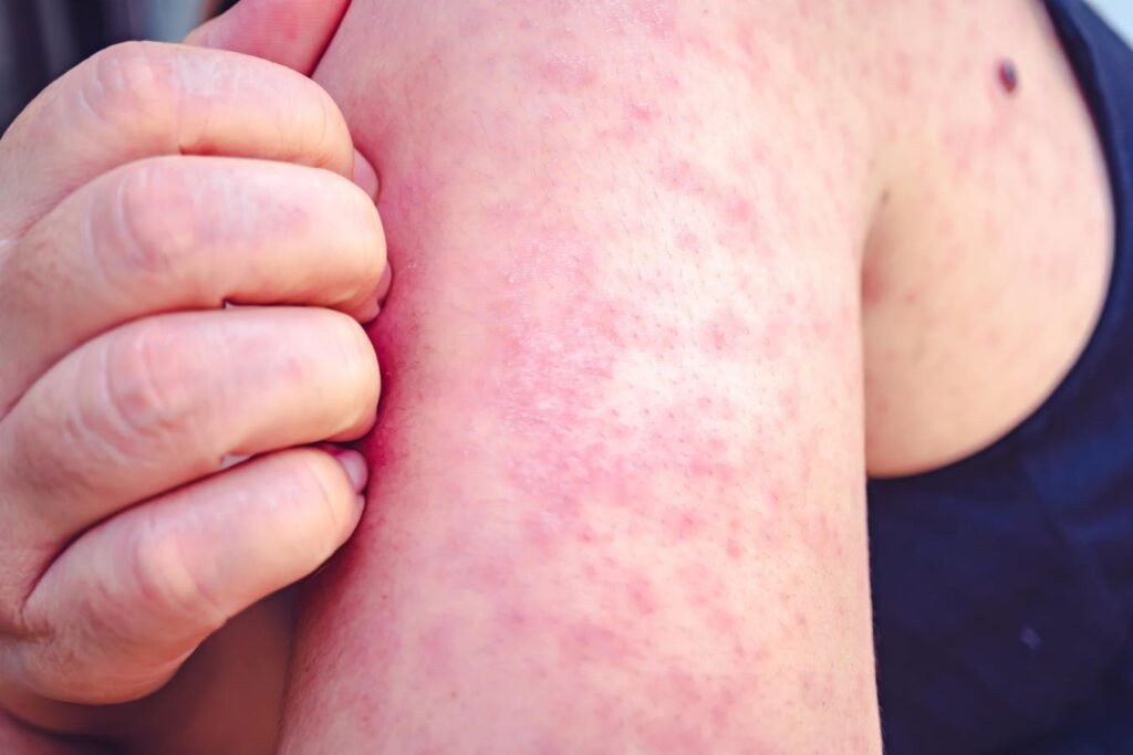 More Than 1 Million Young Britons Urged To Get Measles