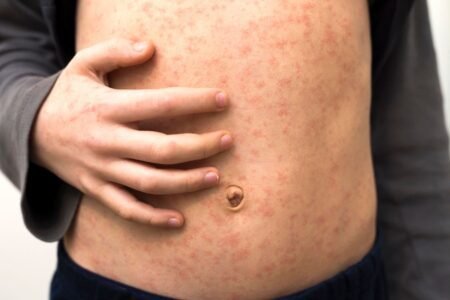 Measles Cases Worldwide Rise 20% In One Year, With Poor