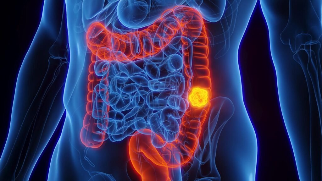 She shouldn’t have had her colonoscopy. A blood test found cancer anyway She Shouldn't Have Had Her Colonoscopy. A Blood Test Found