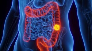 She Shouldn't Have Had Her Colonoscopy. A Blood Test Found